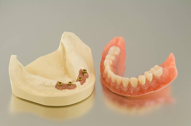 Model of the jaw and implant denture