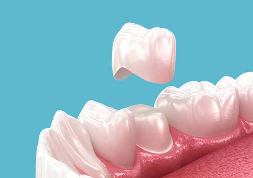 Dental crown placement over tooth. 3D illustration