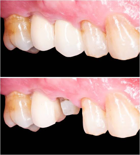 Before and after picture for zirkon crown placing