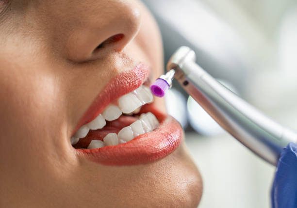 Closeup shot of teeth whitening procedure , young woman patient