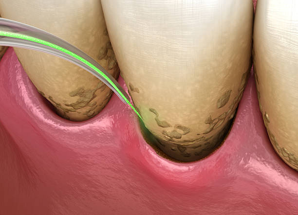 Laser removes tartar and thin layer of infected skin